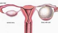صورة مقال تكيس أم أكياس المبايض