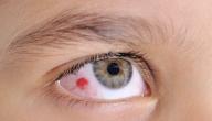 صورة مقال أورام العيون
