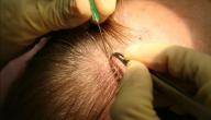 صورة مقال طريقة زراعة الشعر