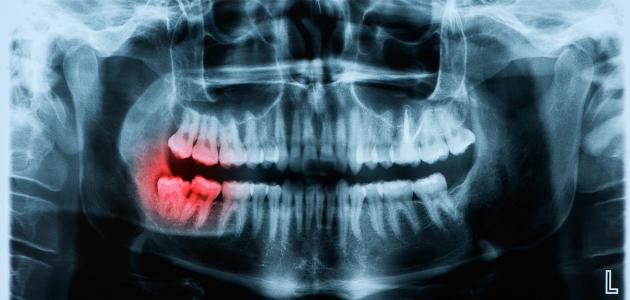 خلع ضرس العقل صورة مقال خلع ضرس العقل