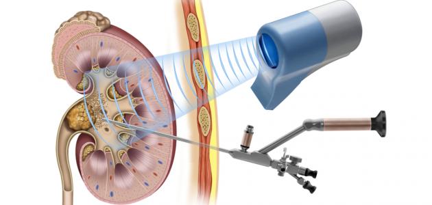 علاج حصوات الكلى صورة مقال علاج حصوات الكلى