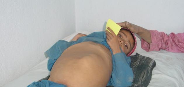 علاج تضخم الطحال صورة مقال علاج تضخم الطحال