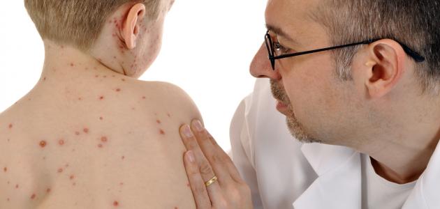 مضاعفات مرض الحصبة صورة مقال مضاعفات مرض الحصبة