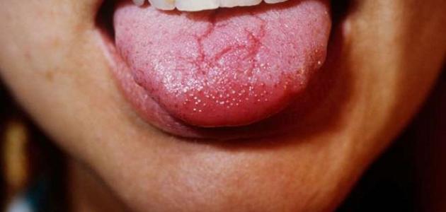 أسباب تشقق اللسان وعلاجه صورة مقال أسباب تشقق اللسان وعلاجه