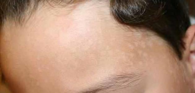 أسباب بقع الوجه صورة مقال أسباب بقع الوجه