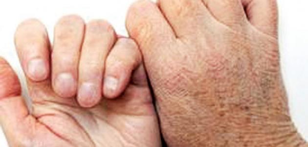 أسباب جفاف الجلد الشديد صورة مقال أسباب جفاف الجلد الشديد