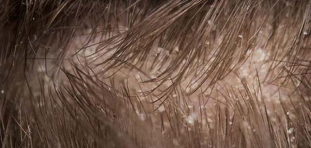 أسباب قشرة الرأس وعلاجها صورة مقال أسباب قشرة الرأس وعلاجها