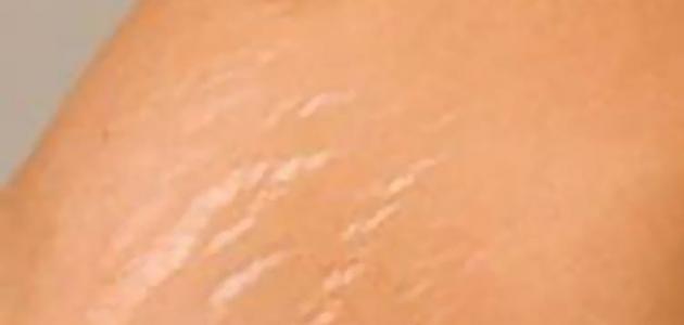 أسباب تشققات الجلد صورة مقال أسباب تشققات الجلد