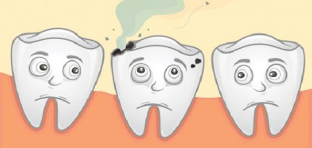 إزالة تسوس الأسنان صورة مقال إزالة تسوس الأسنان