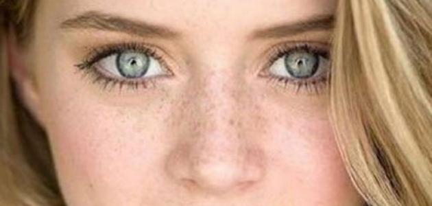 إزالة النمش طبيعياً صورة مقال إزالة النمش طبيعياً