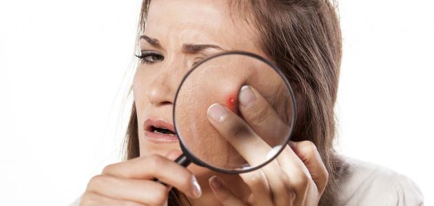 إزالة بقع الحبوب من الوجه صورة مقال إزالة بقع الحبوب من الوجه