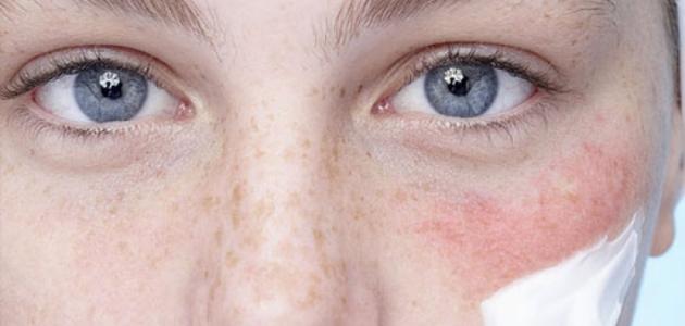 أسباب احمرار الوجه المفاجئ صورة مقال أسباب احمرار الوجه المفاجئ