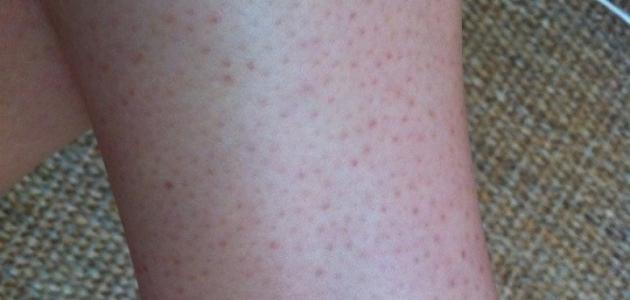 إزالة النقط السوداء من الساقين صورة مقال إزالة النقط السوداء من الساقين