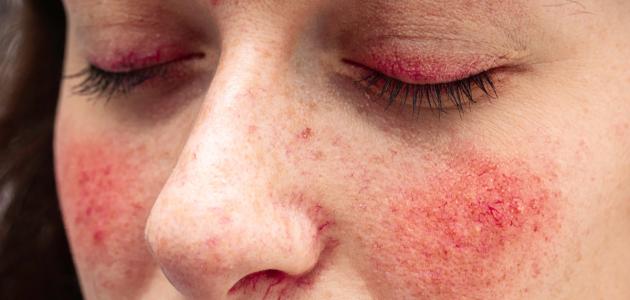 ظهور بقع حمراء على الجلد بدون حكة صورة مقال ظهور بقع حمراء على الجلد بدون حكة