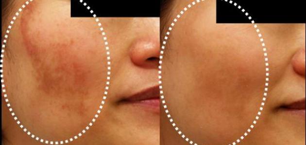 التخلص من النمش والكلف نهائياً صورة مقال التخلص من النمش والكلف نهائياً