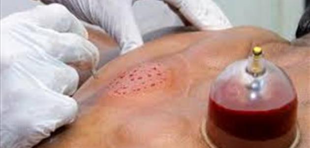 فوائد الحجامة للمدخن صورة مقال فوائد الحجامة للمدخن