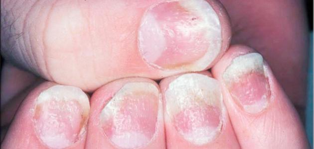 علاج تشقق الاظافر صورة مقال علاج تشقق الاظافر