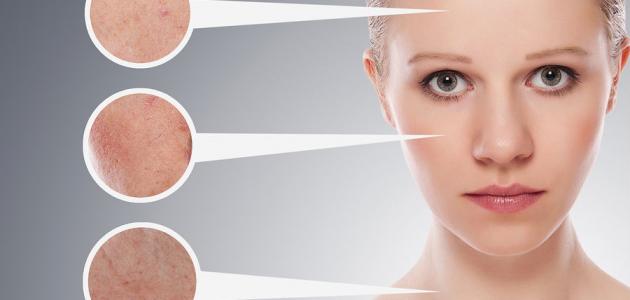 حل للبشرة الدهنية صورة مقال حل للبشرة الدهنية