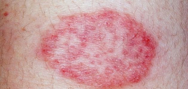 فطريات الجلد الحمراء صورة مقال فطريات الجلد الحمراء