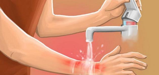 حروق الدرجة الثالثة صورة مقال حروق الدرجة الثالثة