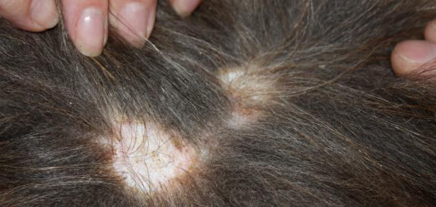 وصفة طبيعية لعلاج الثعلبة صورة مقال وصفة طبيعية لعلاج الثعلبة