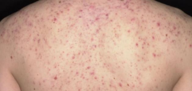 ظهور بثور في الجسم صورة مقال ظهور بثور في الجسم