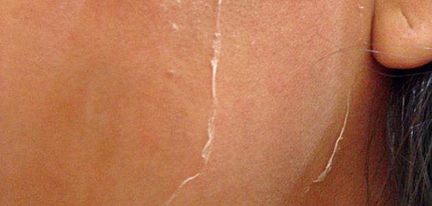 كيف تعالج حروق الوجه صورة مقال كيف تعالج حروق الوجه