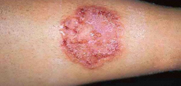 هل تعدي فطريات القطط الإنسان صورة مقال هل تعدي فطريات القطط الإنسان