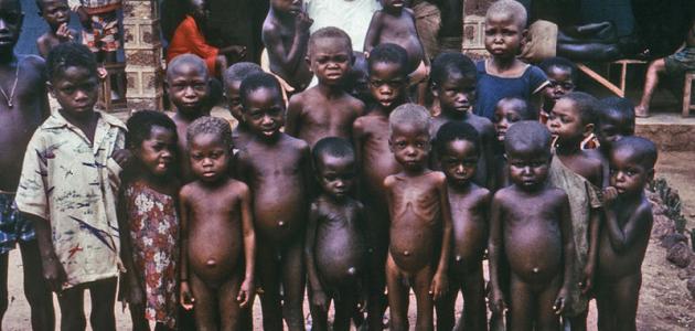 بحث حول مرض الكواشيوركور صورة مقال بحث حول مرض الكواشيوركور