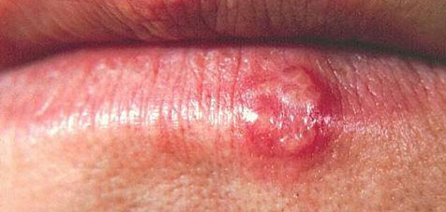 الذئبة الحمراء والجهاز العصبي صورة مقال الذئبة الحمراء والجهاز العصبي