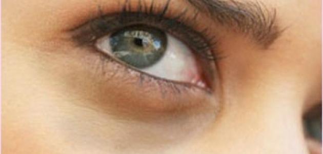 وصفة لإزالة سواد تحت العين صورة مقال وصفة لإزالة سواد تحت العين