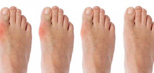 أعراض مرض داء الملوك صورة مقال أعراض مرض داء الملوك