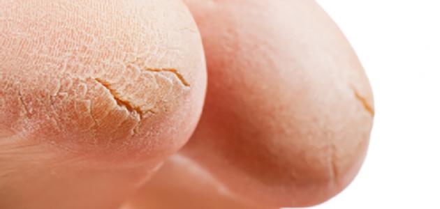 علاج خشونة القدمين بالأعشاب صورة مقال علاج خشونة القدمين بالأعشاب