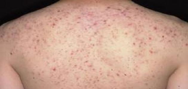 علاج حب الشباب في الظهر والصدر صورة مقال علاج حب الشباب في الظهر والصدر