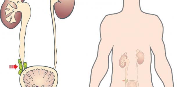 ما علاج احتقان البروستاتا صورة مقال ما علاج احتقان البروستاتا