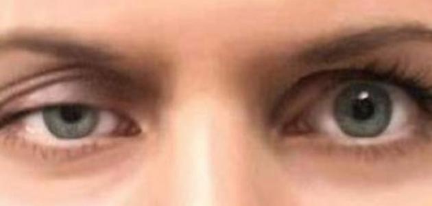 الغدة الدرقية وأمراض العين صورة مقال الغدة الدرقية وأمراض العين