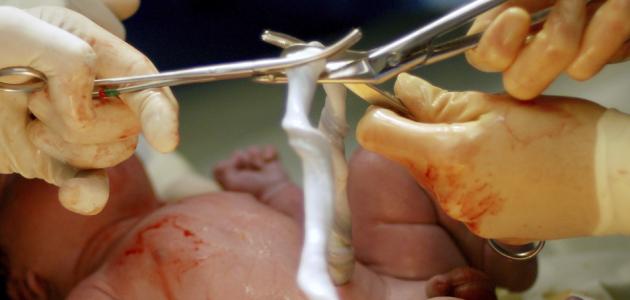 كيف يتم قطع الحبل السري صورة مقال كيف يتم قطع الحبل السري