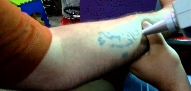 كيف تتم إزالة الوشم صورة مقال كيف تتم إزالة الوشم