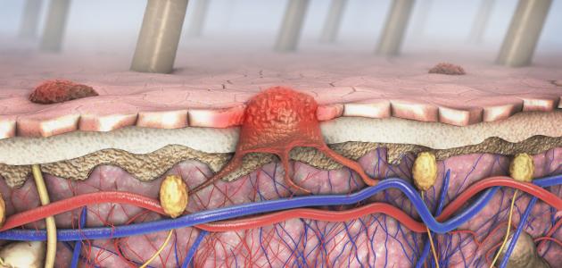 كم عدد مراحل مرض السرطان صورة مقال كم عدد مراحل مرض السرطان