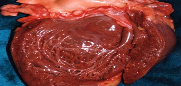 ما هو تضخم القلب صورة مقال ما هو تضخم القلب