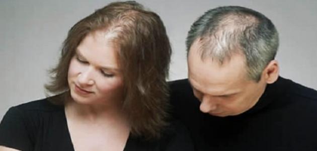 نقص فيتامين د يسبب تساقط الشعر صورة مقال نقص فيتامين د يسبب تساقط الشعر