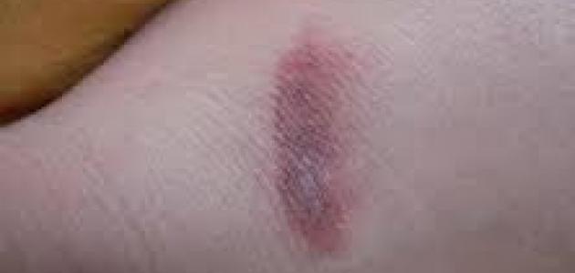 هل الليزر يزيل آثار الحروق صورة مقال هل الليزر يزيل آثار الحروق