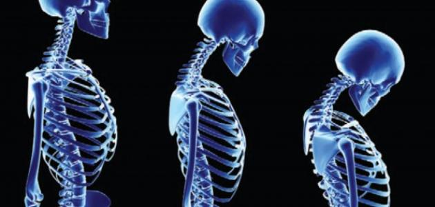 ضعف العظام عند الشباب صورة مقال ضعف العظام عند الشباب