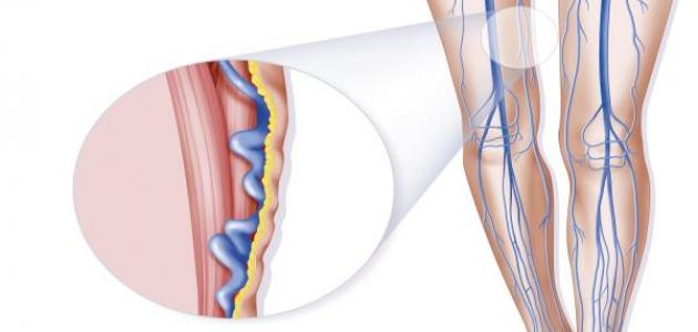 علاج طبيعي لدوالي الساقين صورة مقال علاج طبيعي لدوالي الساقين