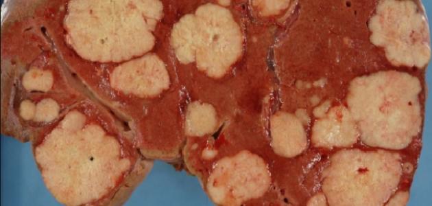 ما هو ورم الكبد صورة مقال ما هو ورم الكبد