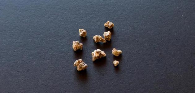 ما هي أعراض حصوات المرارة صورة مقال ما هي أعراض حصوات المرارة