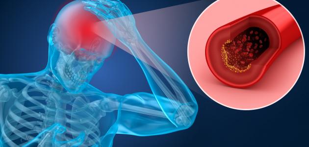 ما هو نقص التروية صورة مقال ما هو نقص التروية