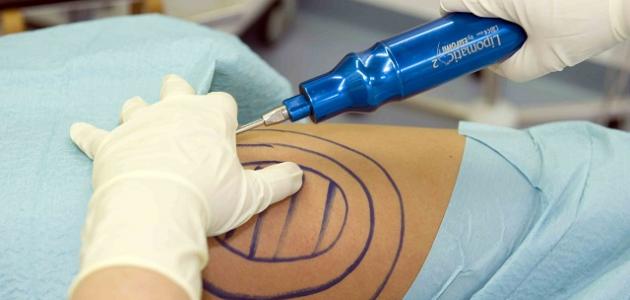 فوائد عملية شفط الدهون صورة مقال فوائد عملية شفط الدهون