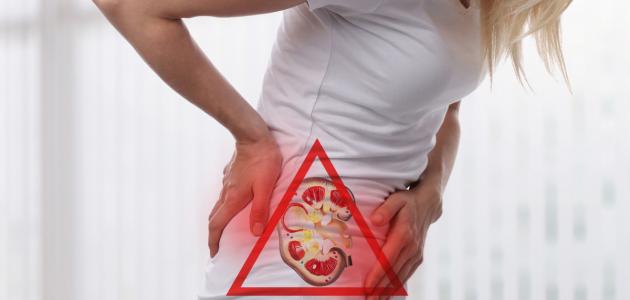 ما هى أعراض حصوات الكلى صورة مقال ما هى أعراض حصوات الكلى