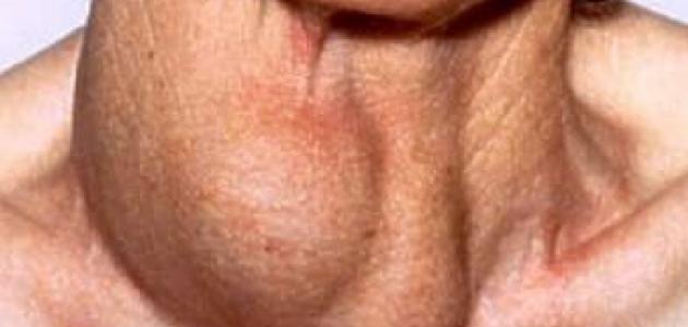 ما هي الغدد اللمفاوية صورة مقال ما هي الغدد اللمفاوية